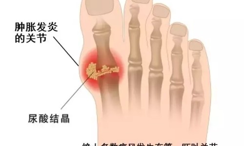 痛风治疗方案及其用药原则-痛风治疗用药方案网 :分享痛风药物治疗方案-痛风治疗的常用药知识